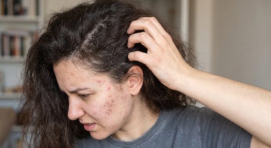 A woman struggling with dandruff, acne, and frizzy hair